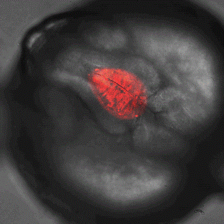 amyotrophic lateral