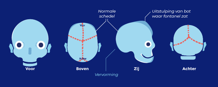 Crouzonsyndroom schedels