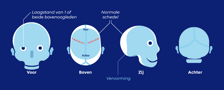 Saethre-chotzensyndroom schedels